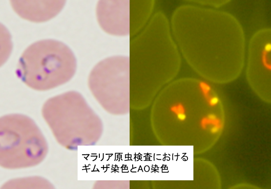 マラリア原虫検査におけるギムザ染色とAO染色